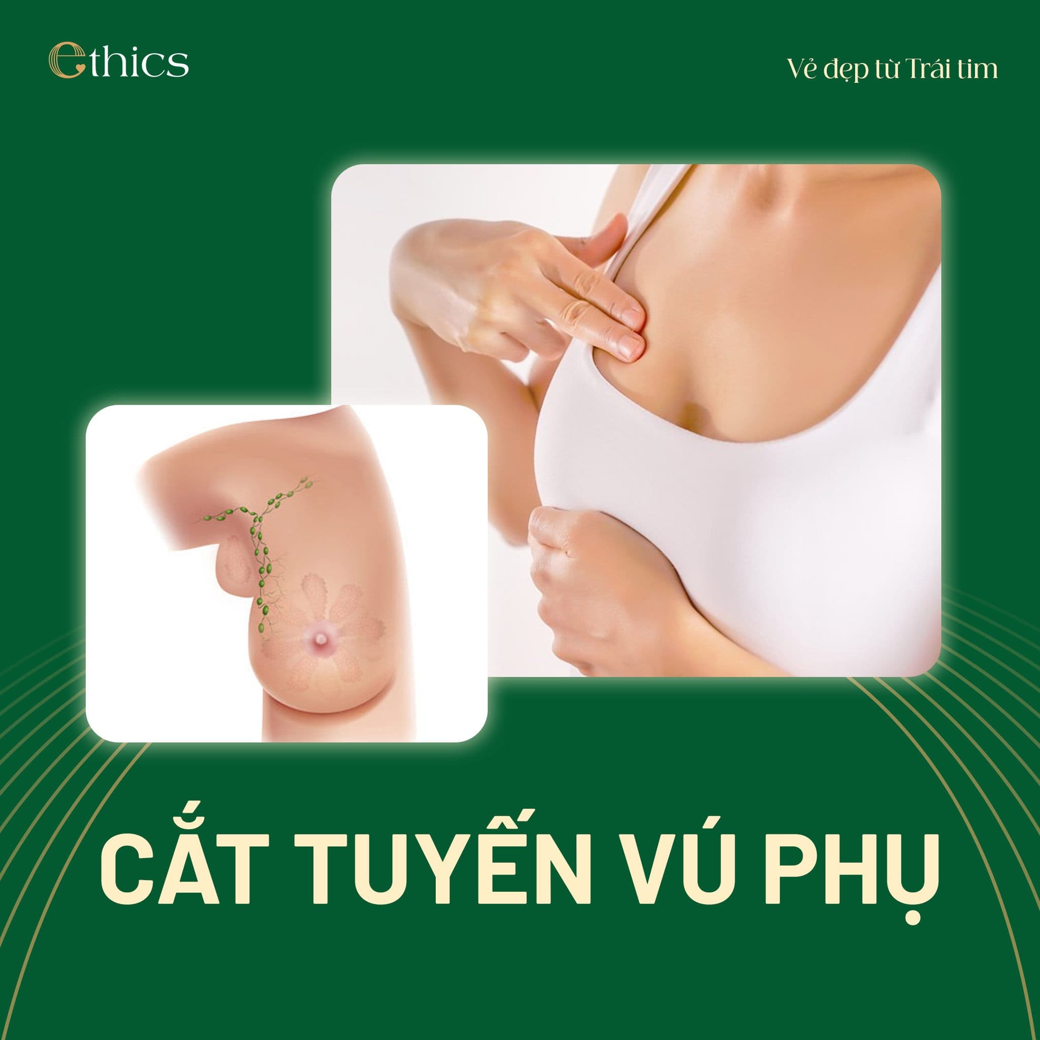 Pembuangan Tisu Payudara Tambahan
