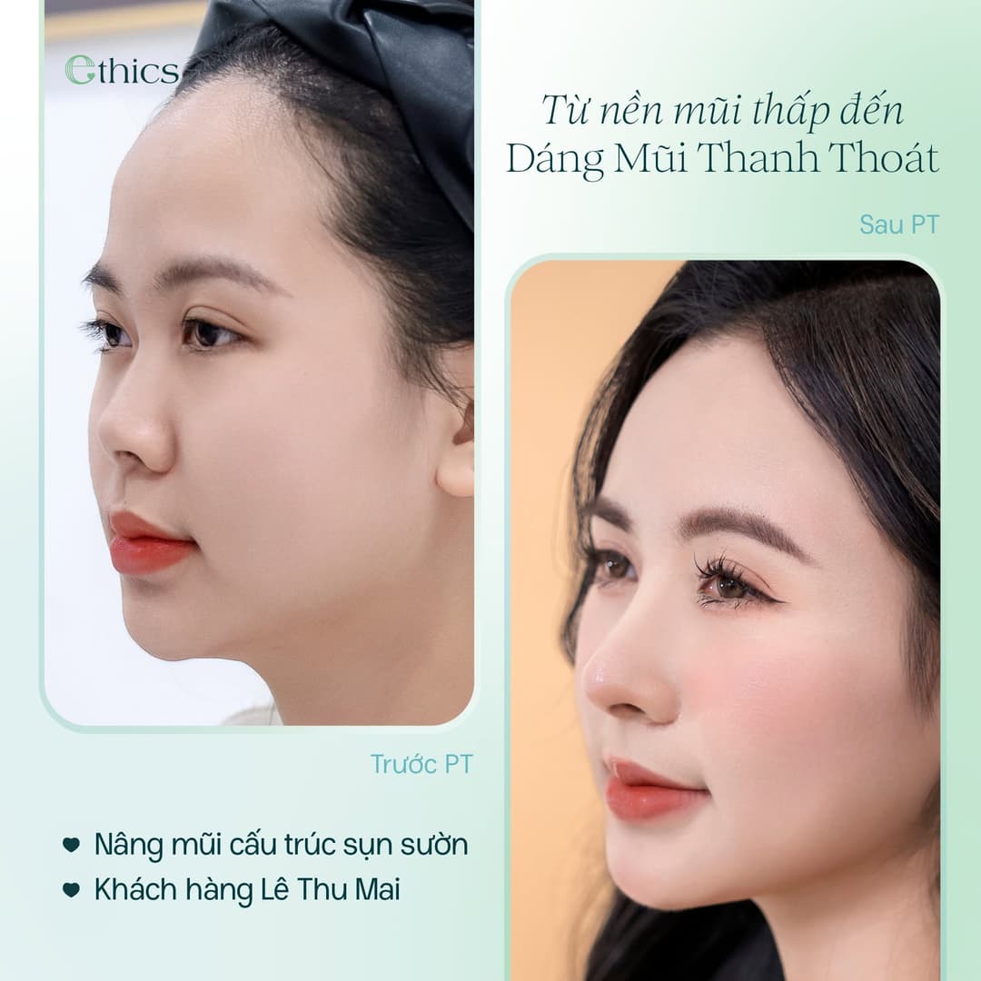 Gambar kes rhinoplasti struktur cartilage rusuk Lê Thu Mai yang diterbitkan oleh Ethics pada 20/09/2026