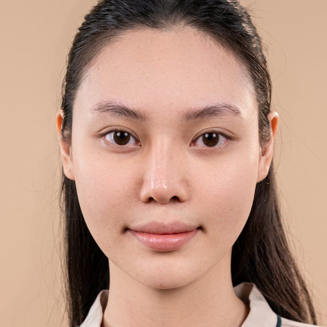 Pelanggan Lưu Phương Anh - Sebelum rawatan rhinoplasti One fit