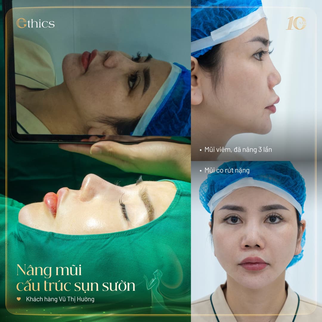 Augmentasi hidung struktur tulang rawan rusuk autologus di Klinik Pakar Ethics