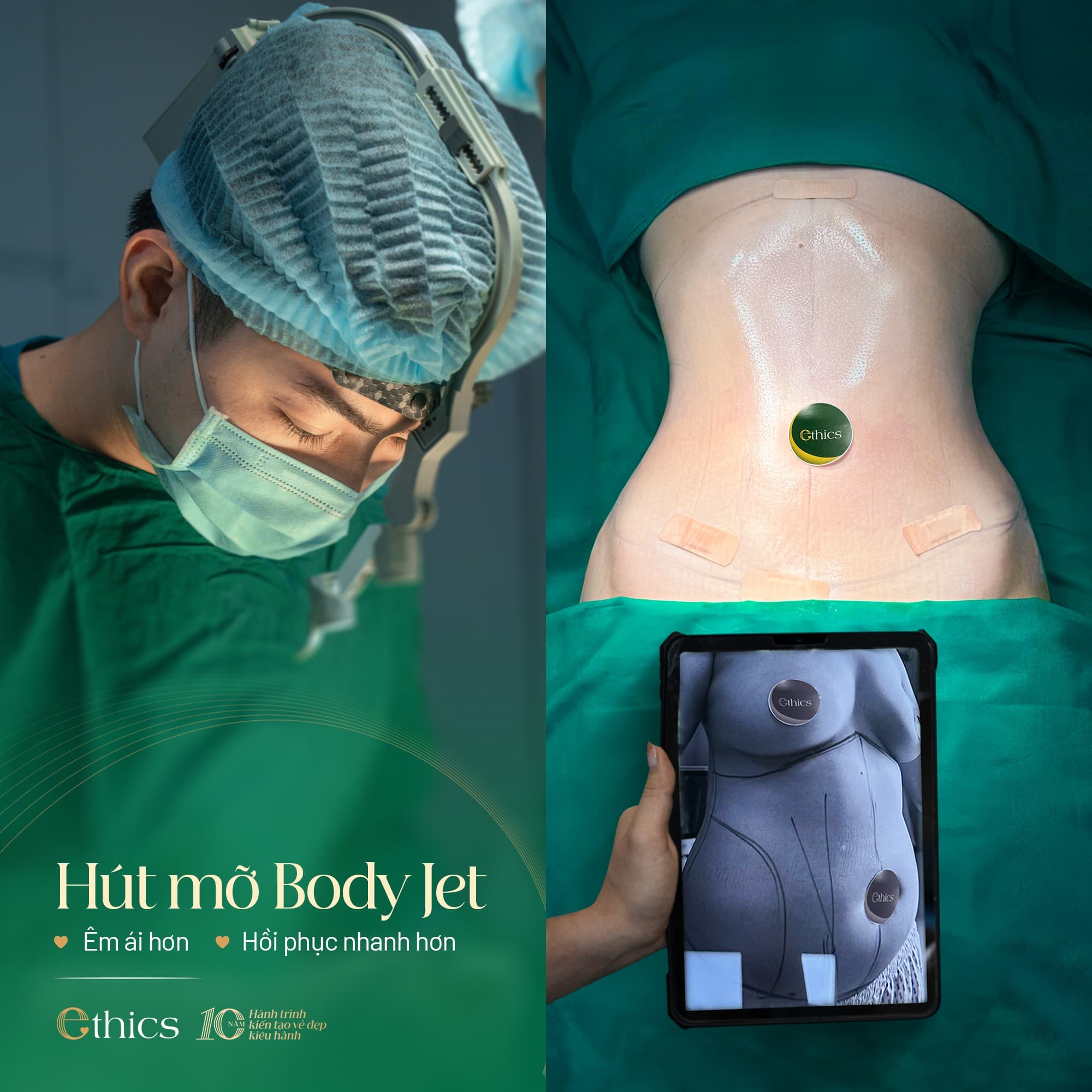 Pemindahan lemak menggunakan teknologi Body Jet