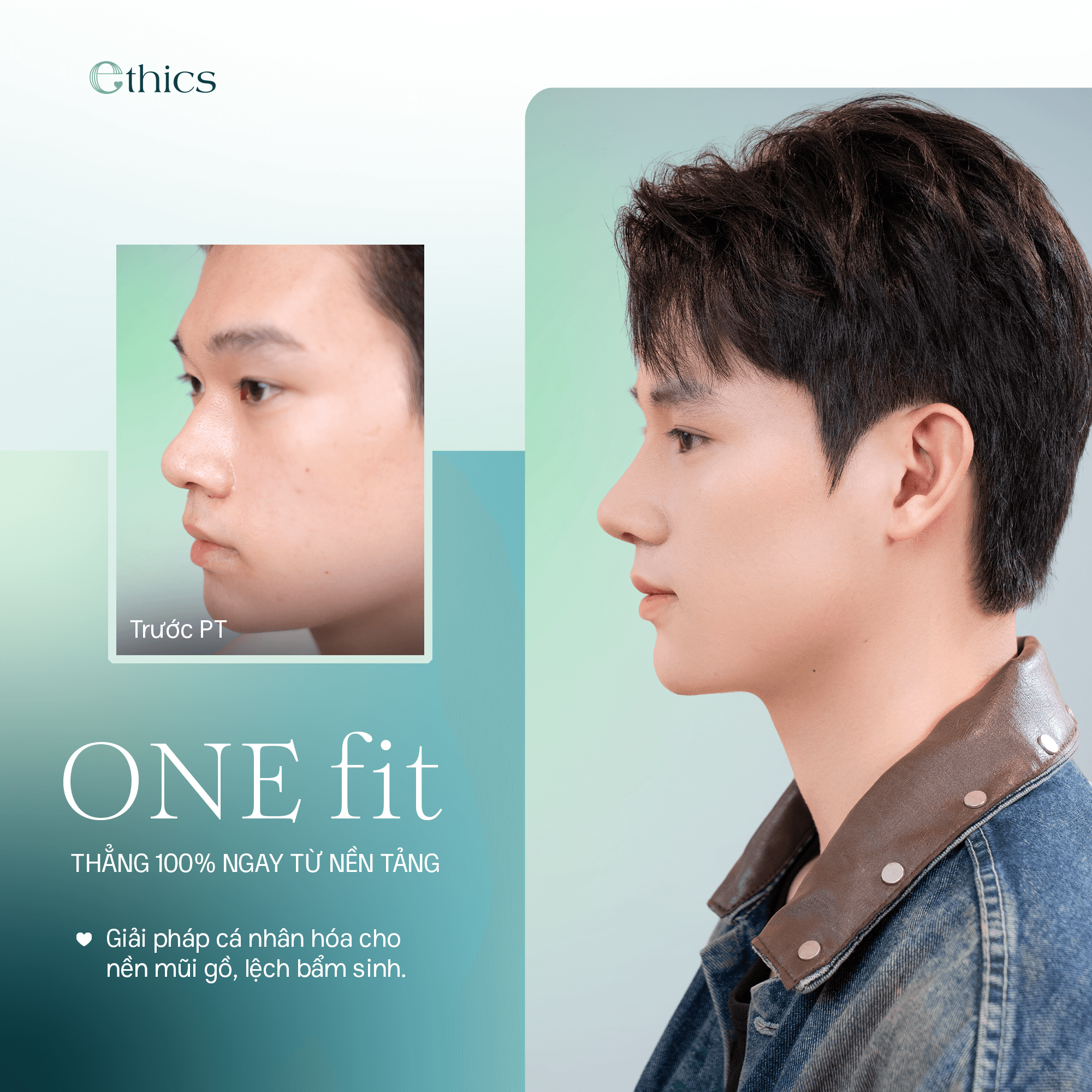 Pembesaran hidung dengan teknik OneFit