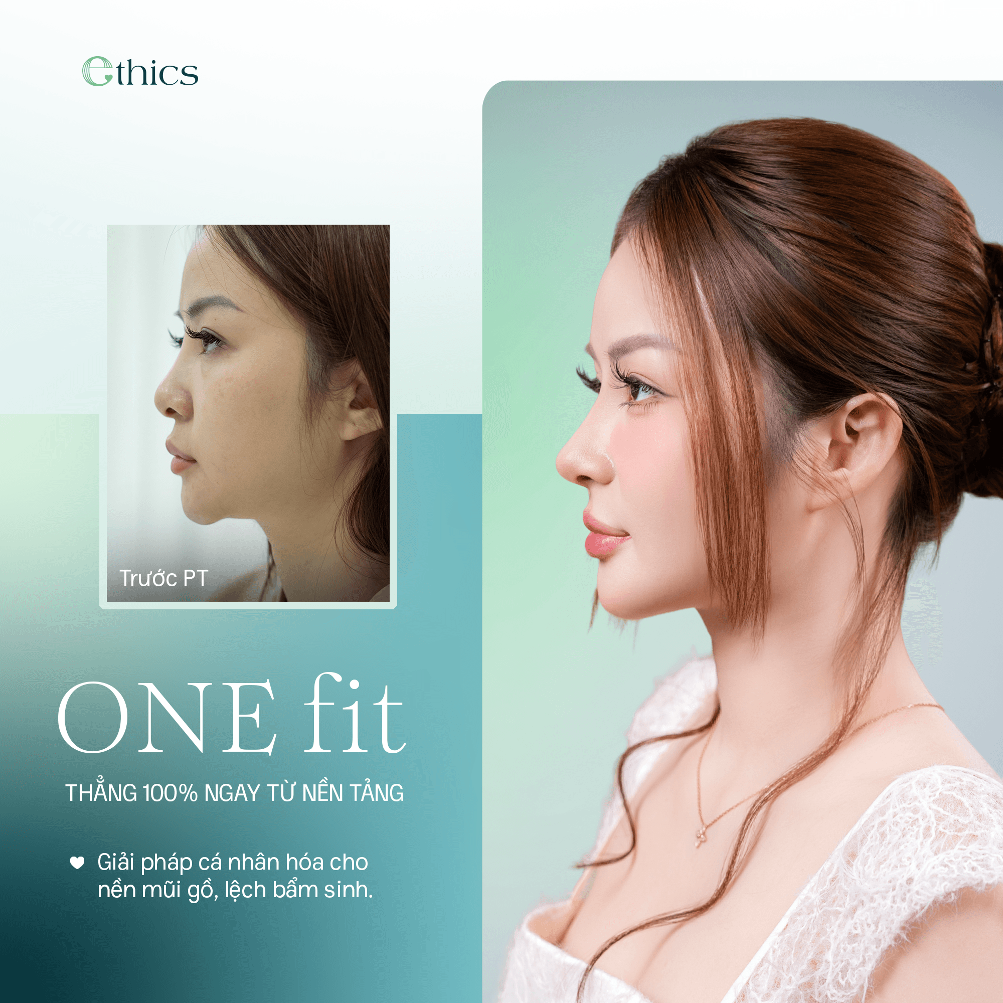 Pembesaran hidung dengan teknologi OneFit Premium