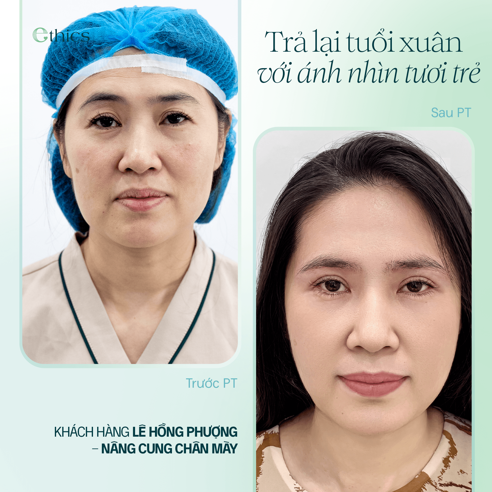 NÂNG CUNG CHÂN MÀY: TRẢ LẠI TUỔI XUÂN VỚI ÁNH NHÌN TƯƠI TRẺ