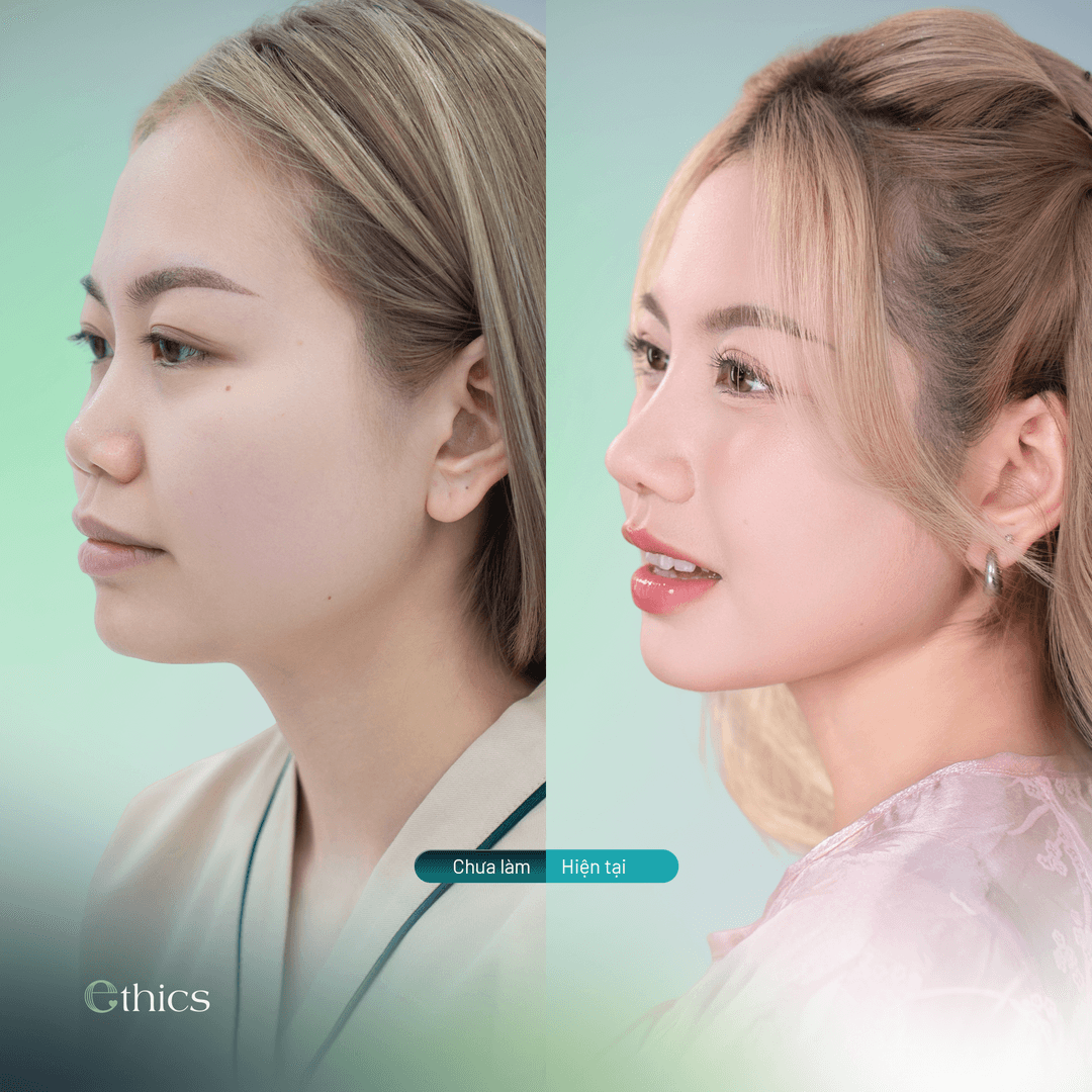 Imej perbandingan sebelum dan selepas augmentasi hidung pelanggan
