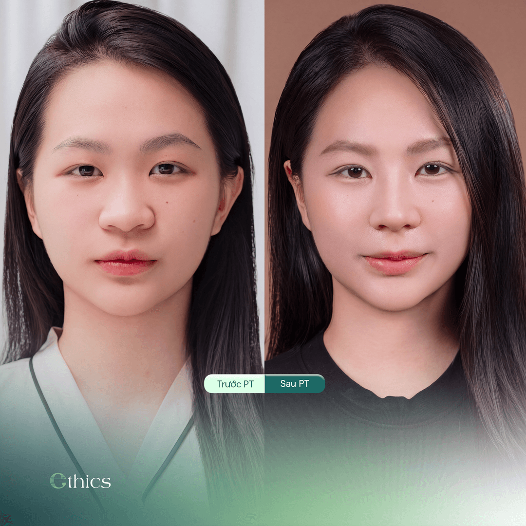 Gambar perbandingan sebelum dan selepas pembedahan rhinoplasty (pembaikan bentuk hidung) bagi seorang pelanggan
