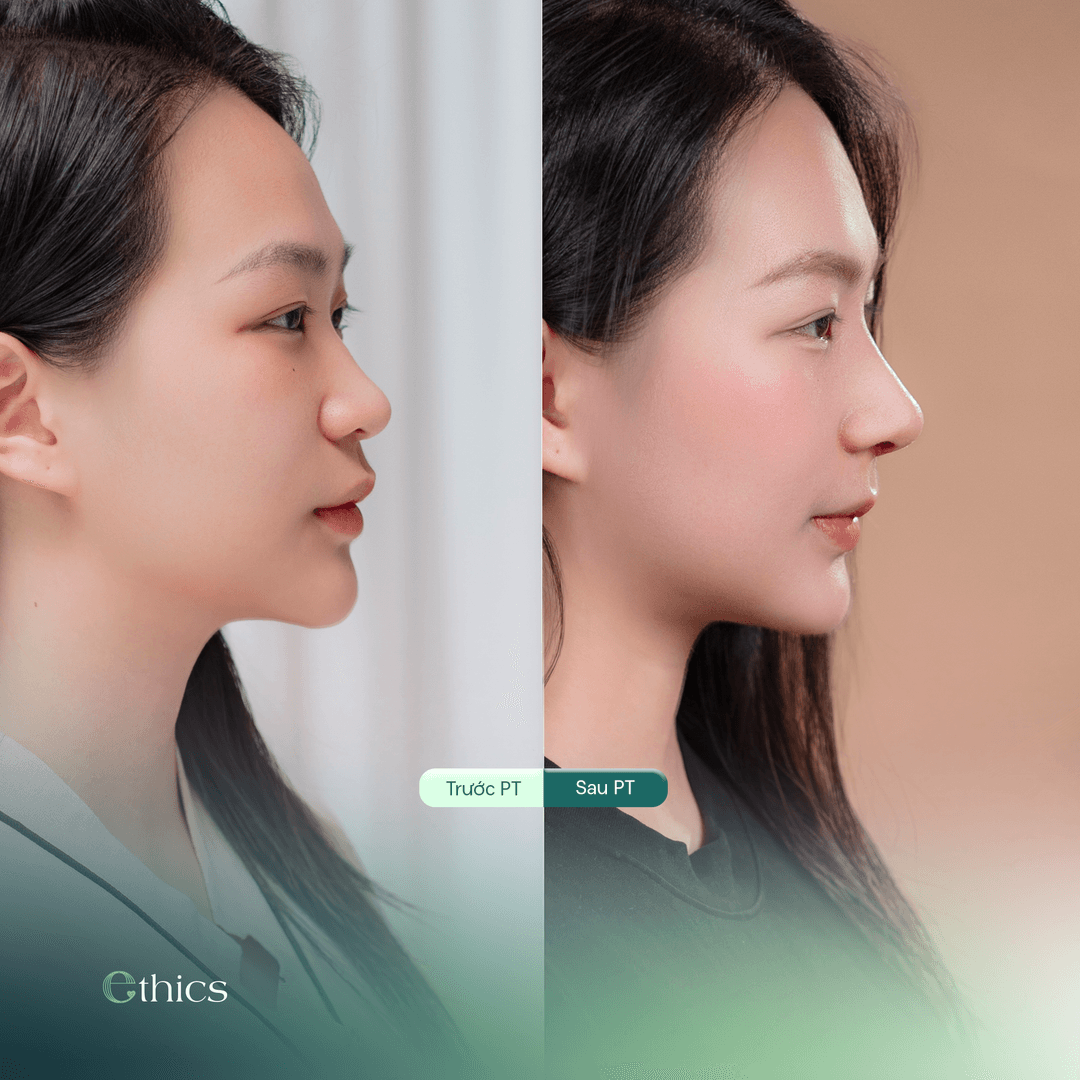 Gambar perbandingan sebelum dan selepas rhinoplasti hidung dari sisi pelanggan