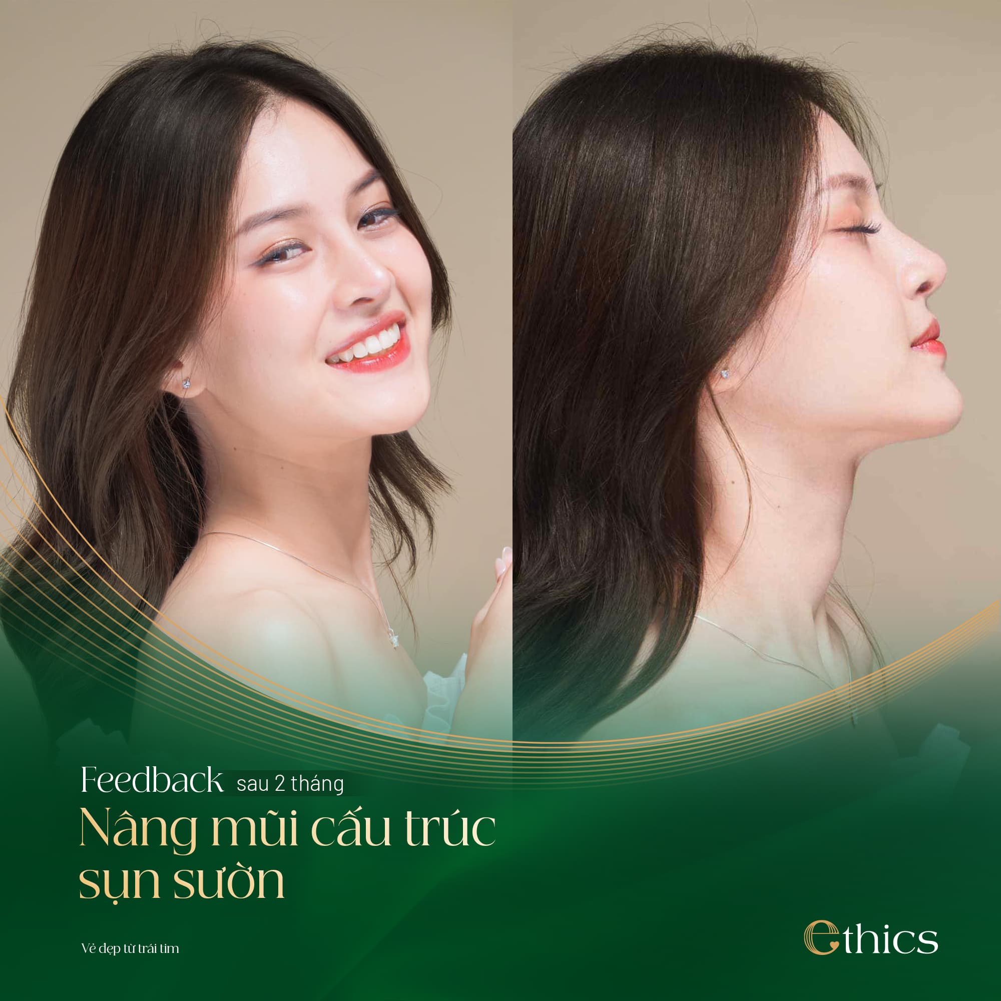 Pembedahan Hidung Struktur (Rhinoplasty Struktur)