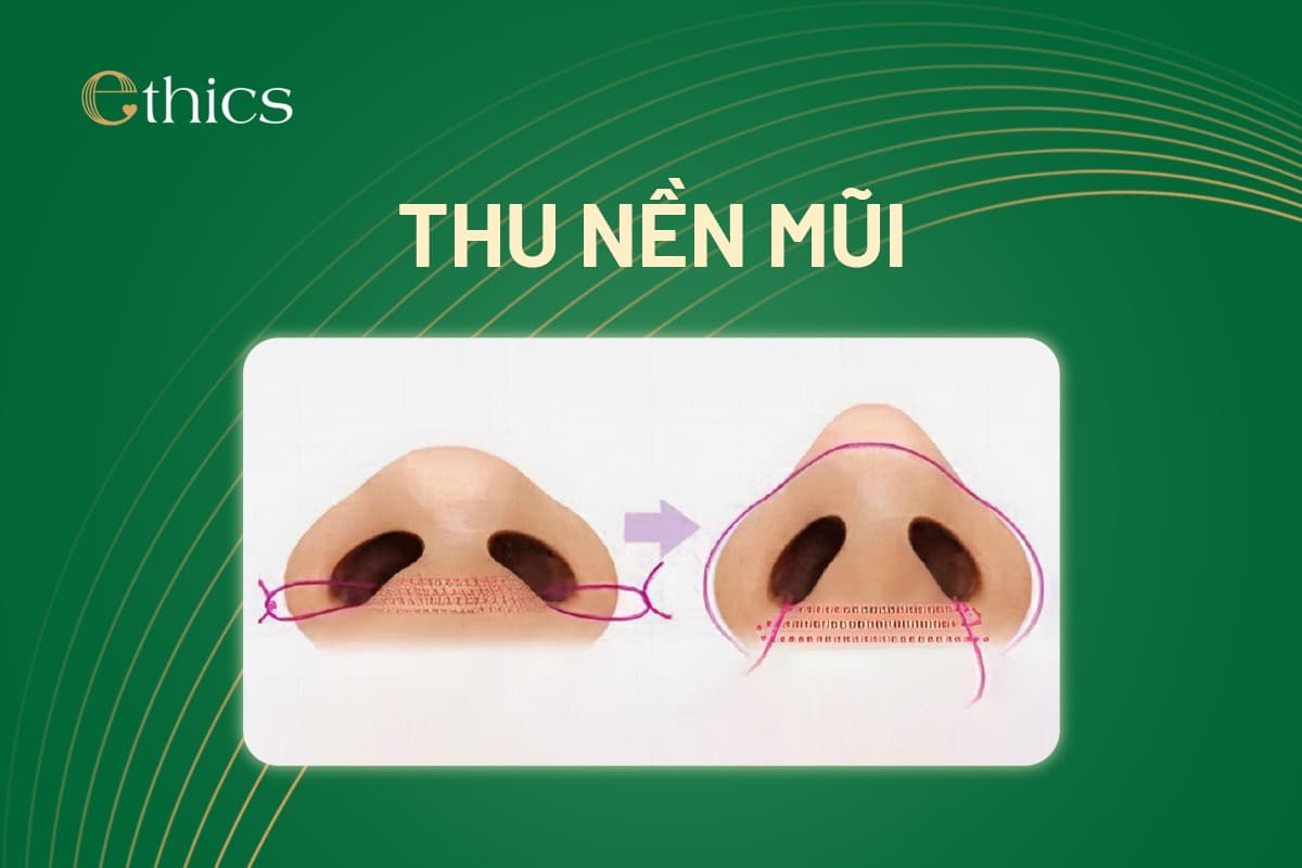 Pengecilan Dasar Hidung