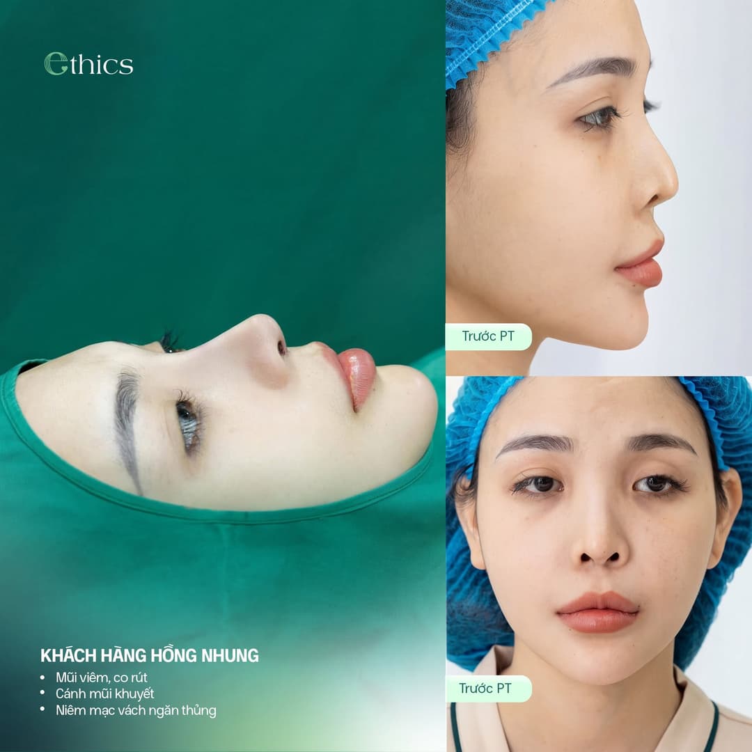 Imej daripada siaran Ethics: pelanggan Hồng Nhung, label “Mũi viêm, co rút”, “Cánh mũi khuyết” dan “Niêm mạc vách ngăn thủng”, disertakan dua imej berlabel Trước PT