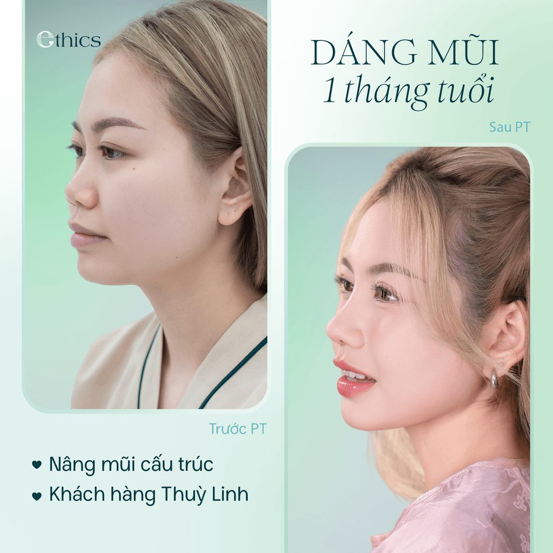 Gambar perbandingan sebelum dan selepas pembedahan hidung struktur pelanggan